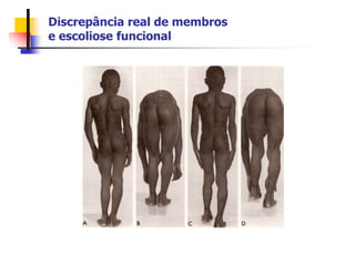 Discrepância real de membros
e escoliose funcional
 