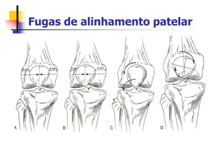 Fugas de alinhamento patelar
 