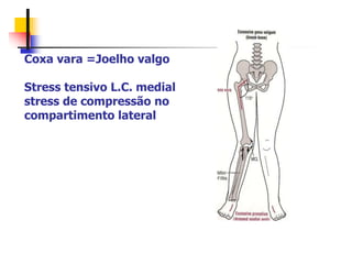 Coxa vara =Joelho valgo
Stress tensivo L.C. medial
stress de compressão no
compartimento lateral
 