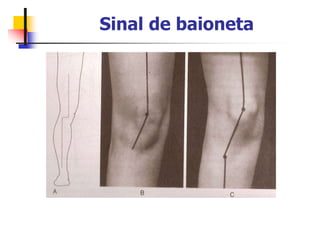 Sinal de baioneta
 