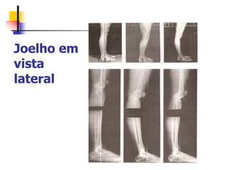 Joelho em
vista
lateral
 