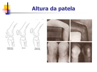 Altura da patela
 