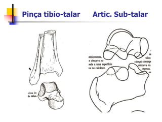 Pinça tibio-talar Artic. Sub-talar
 