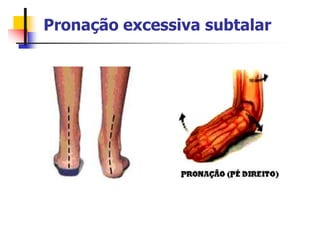Pronação excessiva subtalar
 