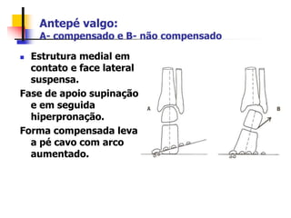 Antepé valgo:
A- compensado e B- não compensado
 Estrutura medial em
contato e face lateral
suspensa.
Fase de apoio supinação
e em seguida
hiperpronação.
Forma compensada leva
a pé cavo com arco
aumentado.
 