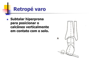 Retropé varo
 Subtalar hiperprona
para posicionar o
calcâneo verticalmente
em contato com o solo.
 
