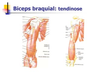 Biceps braquial: tendinose
 