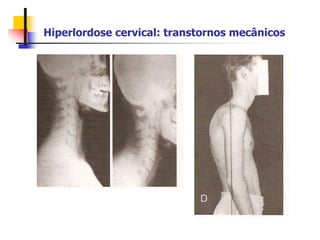 Hiperlordose cervical: transtornos mecânicos
 