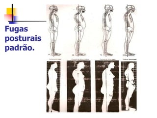 Fugas
posturais
padrão.
 
