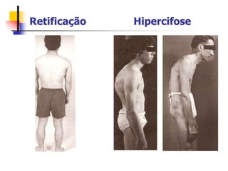 Retificação Hipercifose
 