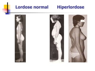 Lordose normal Hiperlordose
 