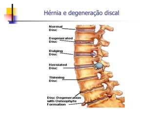 Hérnia e degeneração discal
 