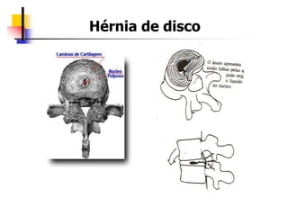 Hérnia de disco
 