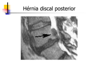 Hérnia discal posterior
 