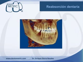 www.dentometric.com Dr. Enrique Sierra Rosales
Reabsorción dentaria
 