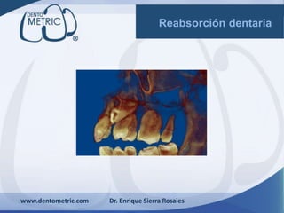 www.dentometric.com Dr. Enrique Sierra Rosales
Reabsorción dentaria
 