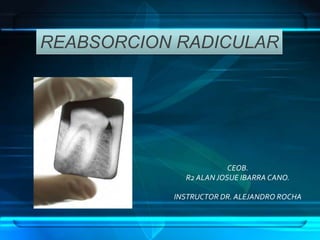 REABSORCION RADICULAR




                        CEOB.
             R2 ALAN JOSUE IBARRA CANO.

           INSTRUCTOR DR. ALEJANDRO ROCHA
 