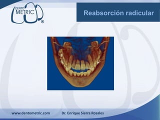 www.dentometric.com Dr. Enrique Sierra Rosales
Reabsorción radicular
 