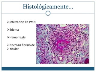 Histológicamente…
Infiltración de PMN
Edema
Hemorragia
Necrosis fibrinoide
tisular