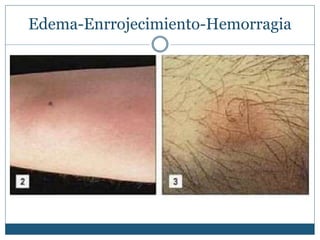 Edema-Enrrojecimiento-Hemorragia