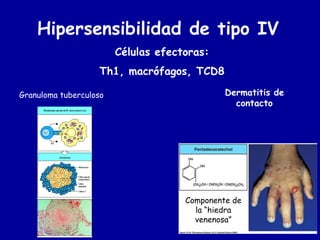 Reacciones De Hipersensibilidad