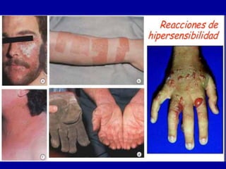 Reacciones De Hipersensibilidad
