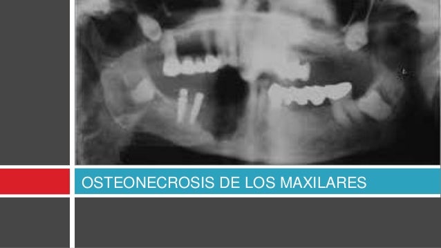 Reacciones Adversas A Bifosfonatos Por Lidia Holgado