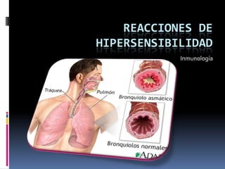 REACCIONES DE
HIPERSENSIBILIDAD
Inmunología
 