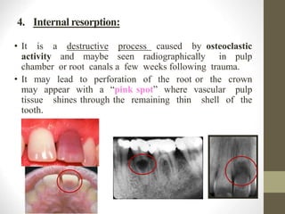 Reaction of teeth to trauma | PPT