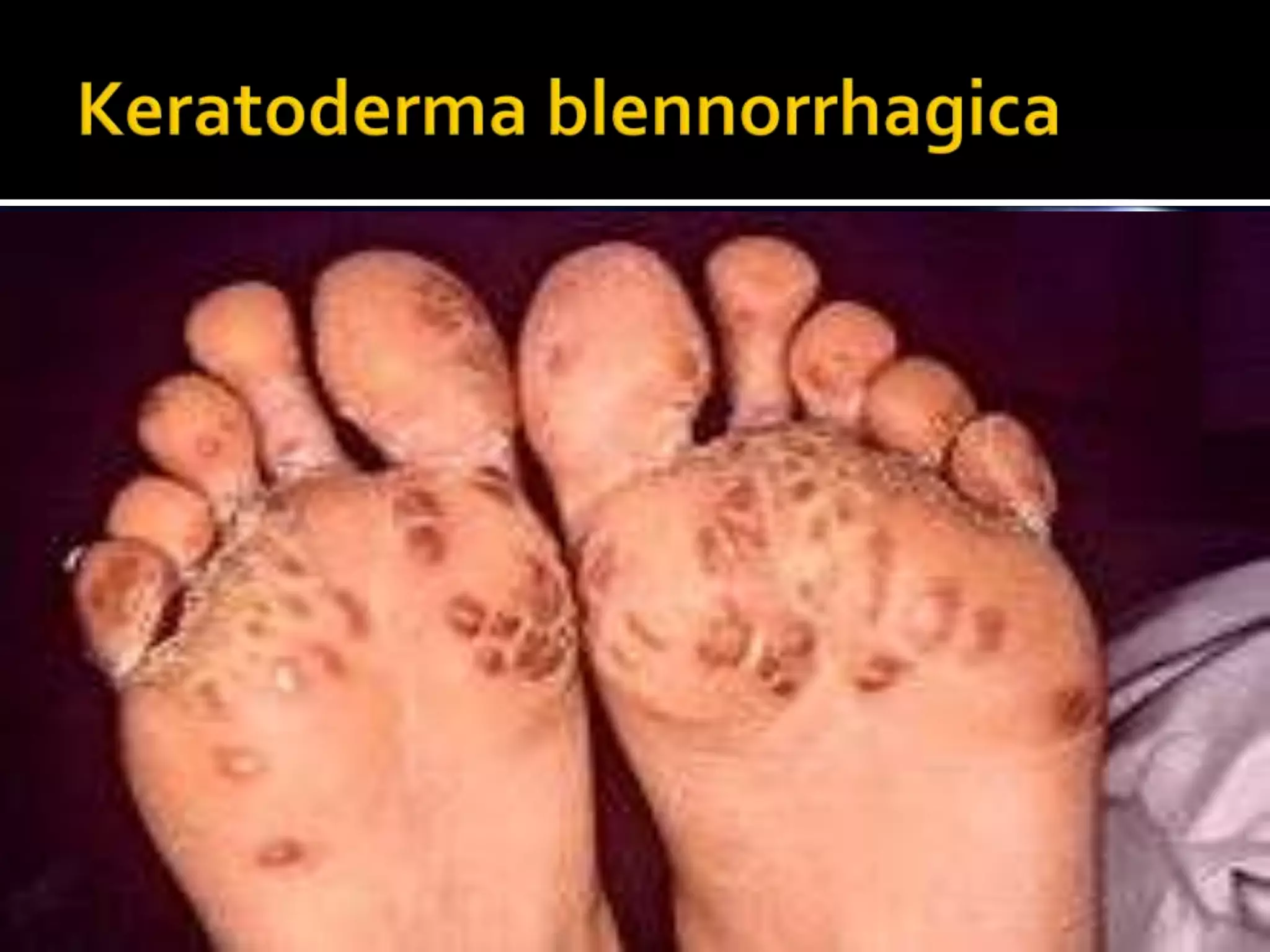 keratoderma blennorrhagica
 