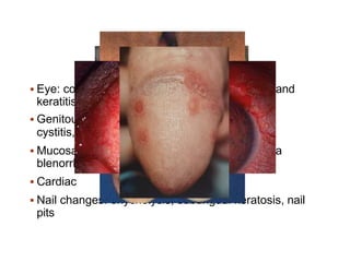  Eye: conjunctivitis, anterior uveitis, episcleritis and
keratitis
 Genitourinary: urethritis, cervicitis, prostatitis,
cystitis, circinate balanitis, salpingo-oophoritis
 Mucosal and skin: mucosal ulcers, keratoderma
blenorrhagica, erythema nodosum
 Cardiac
 Nail changes: onycholysis, subungual keratosis, nail
pits
 
