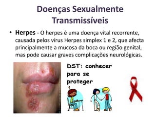 Doenças Sexualmente TransmissíveisHerpes - O herpes é uma doença vital recorrente, causada pelos vírus Herpes simplex 1 e 2, que afecta principalmente a mucosa da boca ou região genital, mas pode causar graves complicações neurológicas.