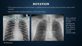 ROTATION
• If the spinous process of vertebral body is equidistant from the medial ends of clavicle, there is NO
rotation.
• Rotation results in reduced distance on the side in front.
Here, reduced
distance is on
the left
meaning the
left side is in
front. Hence,
the patient is
rotated
towards right.
NO Rotation
 