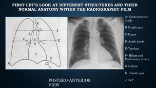 FIRST LET’S LOOK AT DIFFERENT STRUCTURES AND THEIR
NORMAL ANATOMY WITHIN THE RADIOGRAPHIC FILM
POSTERO-ANTERIOR
VIEW
A- Costo-phrenic
angle
B-Diaphragm
C-Heart
D-Aortic knob
E-Trachea
F- Hilum and
Pulmonary artery
G-Carina
H- Fundic gas
J-SVC
 