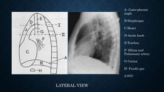LATERAL VIEW
A- Costo-phrenic
angle
B-Diaphragm
C-Heart
D-Aortic knob
E-Trachea
F- Hilum and
Pulmonary artery
G-Carina
H- Fundic gas
J-SVC
 
