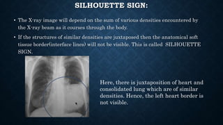 SILHOUETTE SIGN:
• The X-ray image will depend on the sum of various densities encountered by
the X-ray beam as it courses through the body.
• If the structures of similar densities are juxtaposed then the anatomical soft
tissue border(interface lines) will not be visible. This is called SILHOUETTE
SIGN.
Here, there is juxtaposition of heart and
consolidated lung which are of similar
densities. Hence, the left heart border is
not visible.
 