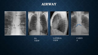 AIRWAY
PA
VIEW
LATERAL
VIEW
CARIN
A
 