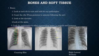 BONES AND SOFT TISSUE
• Bones
1. Look at each rib in turn and look for any pathologies.
2. Count the ribs (From posterior to anterior following the arc).
3. Look at the clavicles.
4.Look at the spine.
5. Look for pathologies in other surrounding bones i.e scapula and humerus.
Counting Ribs Right Lateral
Scoliosis
 