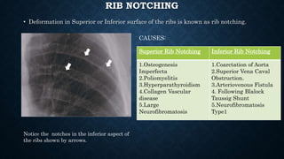RIB NOTCHING
• Deformation in Superior or Inferior surface of the ribs is known as rib notching.
Notice the notches in the inferior aspect of
the ribs shown by arrows.
Superior Rib Notching Inferior Rib Notching
1.Osteogenesis
Imperfecta
2.Poliomyelitis
3.Hyperparathyroidism
4.Collagen Vascular
disease
5.Large
Neurofibromatosis
1.Coarctation of Aorta
2.Superior Vena Caval
Obstruction.
3.Arteriovenous Fistula
4. Following Blalock
Taussig Shunt
5.Neurofibromatosis
Type1
CAUSES:
 