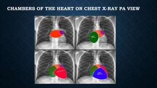 CHAMBERS OF THE HEART ON CHEST X-RAY PA VIEW
 