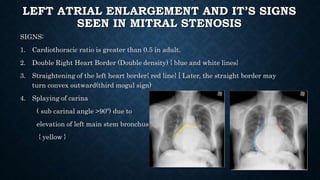 LEFT ATRIAL ENLARGEMENT AND IT’S SIGNS
SEEN IN MITRAL STENOSIS
SIGNS:
1. Cardiothoracic ratio is greater than 0.5 in adult.
2. Double Right Heart Border (Double density) { blue and white lines}
3. Straightening of the left heart border{ red line} [ Later, the straight border may
turn convex outward(third mogul sign)
4. Splaying of carina
( sub carinal angle >90º) due to
elevation of left main stem bronchus
{ yellow }
 