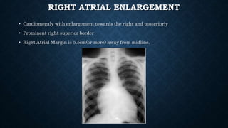 RIGHT ATRIAL ENLARGEMENT
• Cardiomegaly with enlargement towards the right and posteriorly
• Prominent right superior border
• Right Atrial Margin is 5.5cm(or more) away from midline.
 