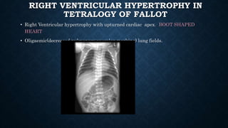 RIGHT VENTRICULAR HYPERTROPHY IN
TETRALOGY OF FALLOT
• Right Ventricular hypertrophy with upturned cardiac apex. BOOT SHAPED
HEART
• Oligaemic(decreased pulmonary vascular marking) lung fields.
 