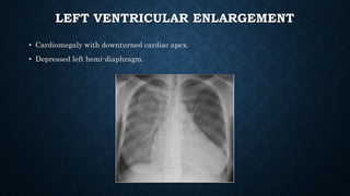 LEFT VENTRICULAR ENLARGEMENT
• Cardiomegaly with downturned cardiac apex.
• Depressed left hemi-diaphragm.
 