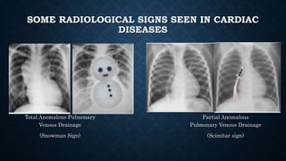 SOME RADIOLOGICAL SIGNS SEEN IN CARDIAC
DISEASES
Total Anomalous Pulmonary
Venous Drainage
(Snowman Sign)
Partial Anomalous
Pulmonary Venous Drainage
(Scimitar sign)
 