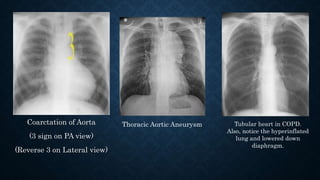 Coarctation of Aorta
(3 sign on PA view)
(Reverse 3 on Lateral view)
Thoracic Aortic Aneurysm Tubular heart in COPD.
Also, notice the hyperinflated
lung and lowered down
diaphragm.
 