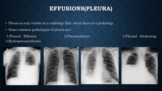 EFFUSIONS(PLEURA)
• Pleura is only visible on a radiology film when there is a pathology.
• Some common pathologies of pleura are:
1.Pleural Effusion 2.Pneumothorax 3.Pleural thickening
4.Hydropneumothorax
 