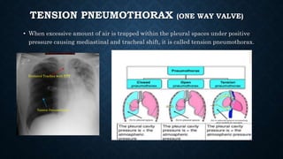 TENSION PNEUMOTHORAX (ONE WAY VALVE)
• When excessive amount of air is trapped within the pleural spaces under positive
pressure causing mediastinal and tracheal shift, it is called tension pneumothorax.
Deviated Trachea with ETT
Tension Pneumothorax
 