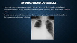 HYDROPNEUMOTHORAX
• Notice the homogeneous dense opacity on the right lung field with horizontal upper
border and the lack of any bronchovascular markings above it. This is called an Air-fluid
level.
• Most common cause of Hydropneumothorax is Iatrogenic (air is accidently introduced
during drainage of pleural effusion)
 