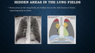 HIDDEN AREAS IN THE LUNG FIELDS
• Some areas in the lung fields are hidden due to the soft tissues or bones
superimposing on them.
 